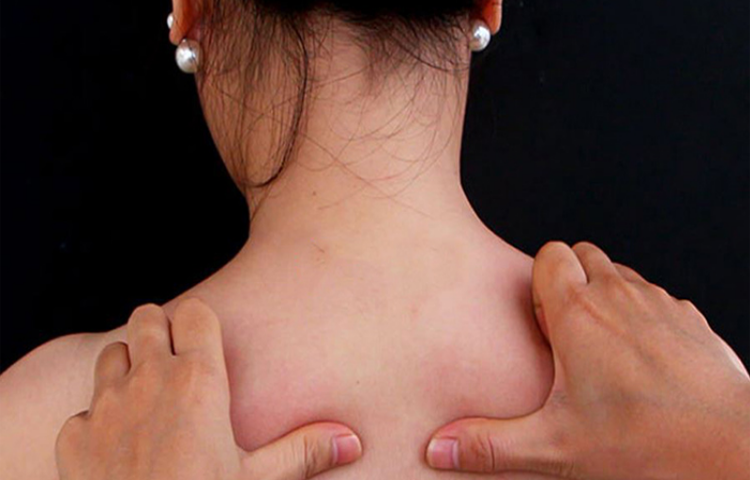 Xoa bóp bấm huyệt điều trị tổn thương rễ, đám rối thần kinh (Chứng nuy)